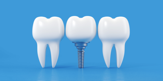 Implantes o puentes dentales Cuál es mejor Space Clinic