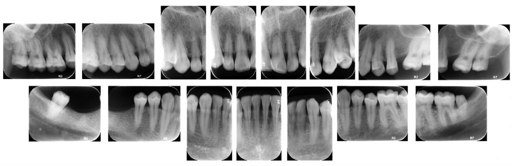 Periapical