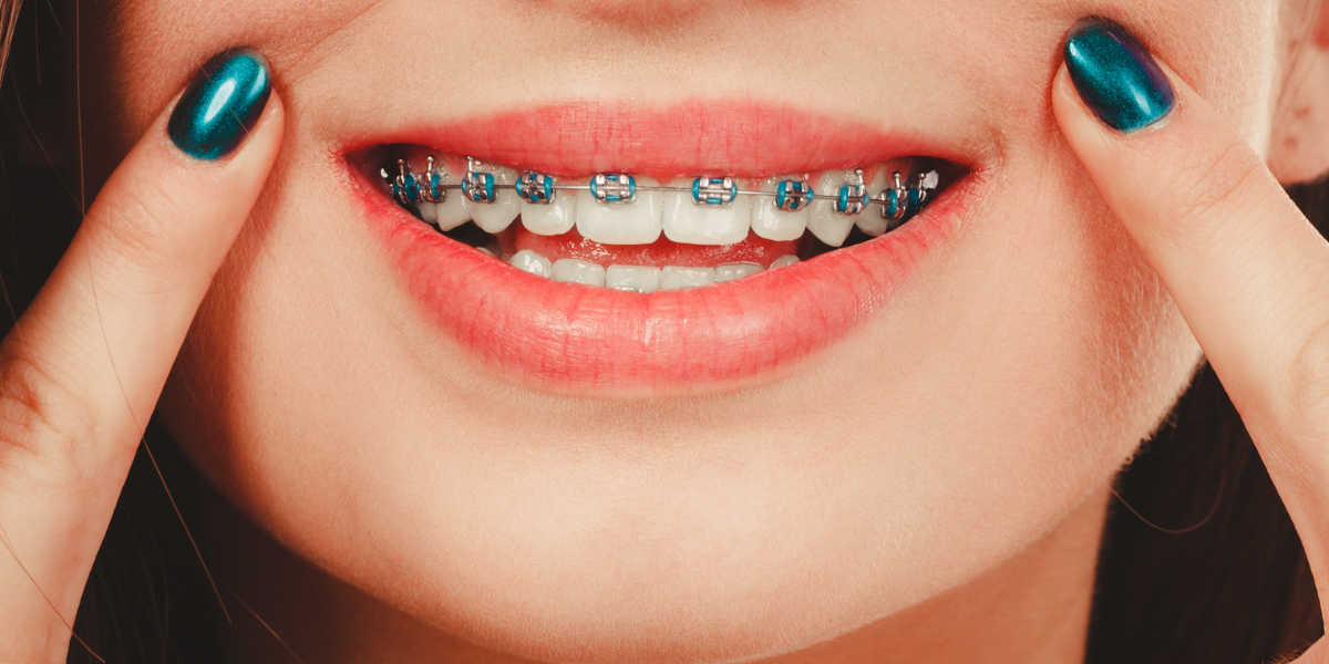 ¿Qué es primero los brackets o el blanqueamiento?