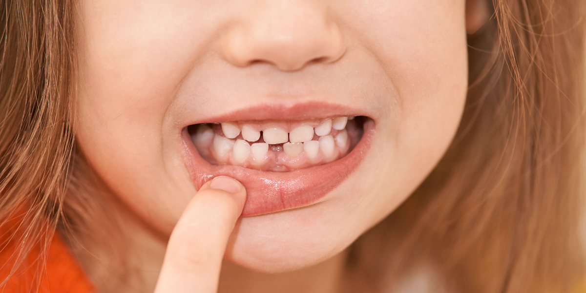 ¿Cómo evitar las caries en los dientes de leche?