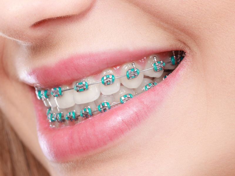 Cómo Lograr que tus Brackets Funcionen más Rápido: Consejos de Space Clinic