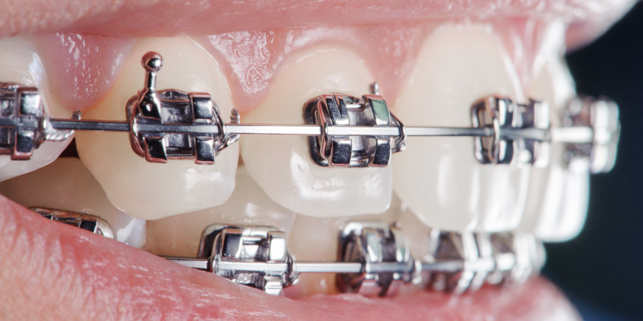 ¡Desmiente los Mitos sobre los Brackets!