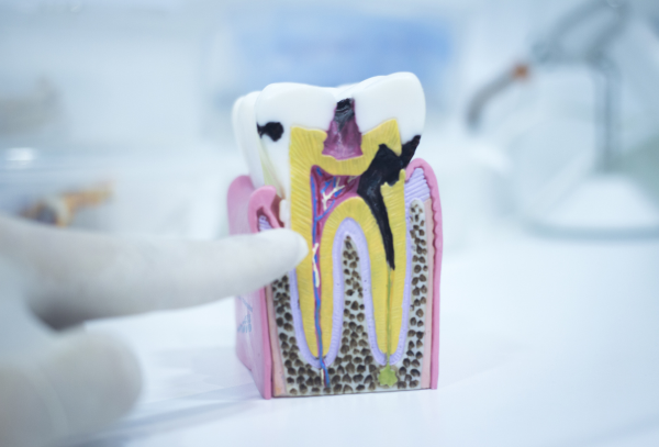 ¿Qué Hacer si Tienes una Caries?